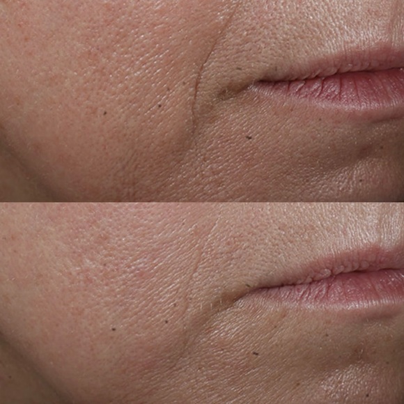 PERRICONE MD COLD PLASMA PLUS+ADVANCED SERUM CONCENTRATE NWT - Picture 5 of 11